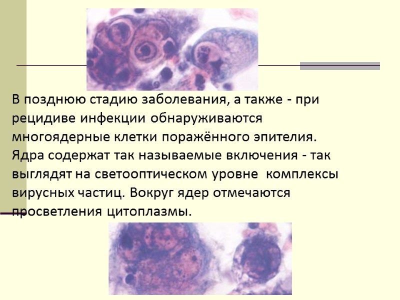 В позднюю стадию заболевания, а также - при рецидиве инфекции обнаруживаются многоядерные клетки поражённого